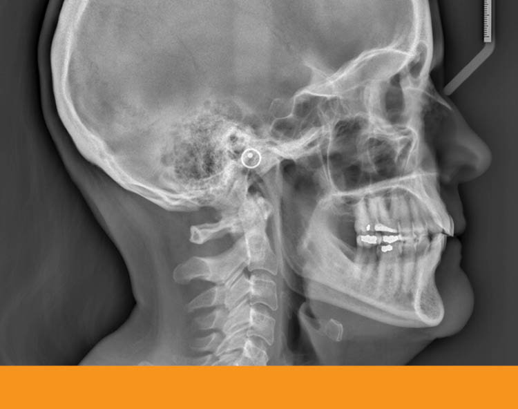 Clear Aligner Therapy and Symptoms of TMDs